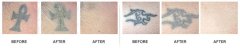 PROFADE 123 PERMANENTNÍ krém na odstranění tetování 3x60 ml