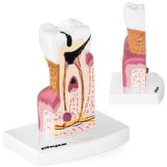 shumee Anatomický model nemocného lidského zubu v měřítku 6:1