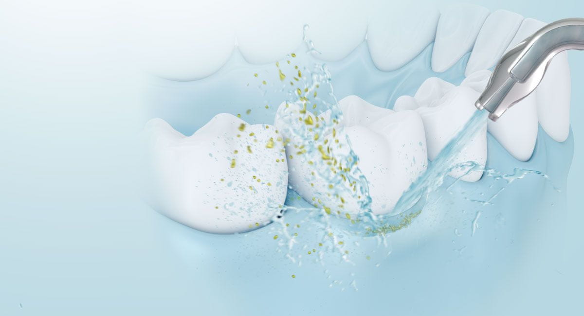 Čiščenje periodontalnih žepov